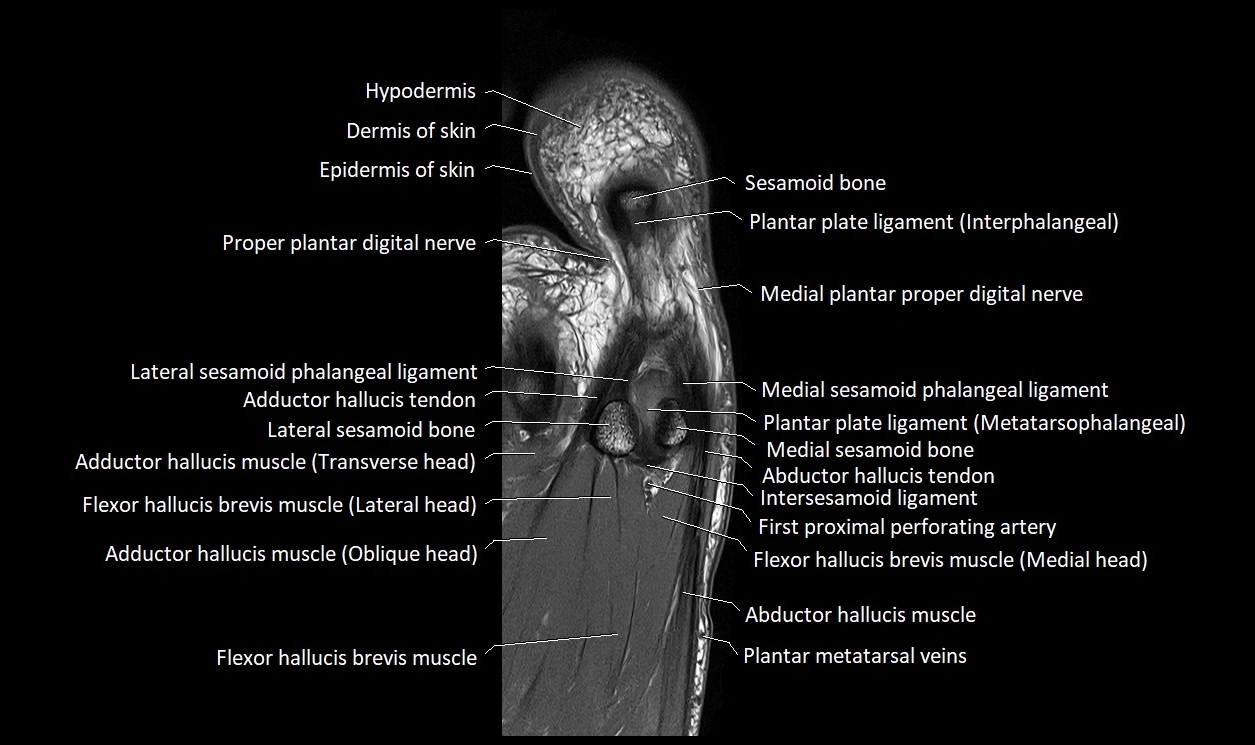 Great Toe micro anatomy MRI axial cross sectional 3T image 20.webp
